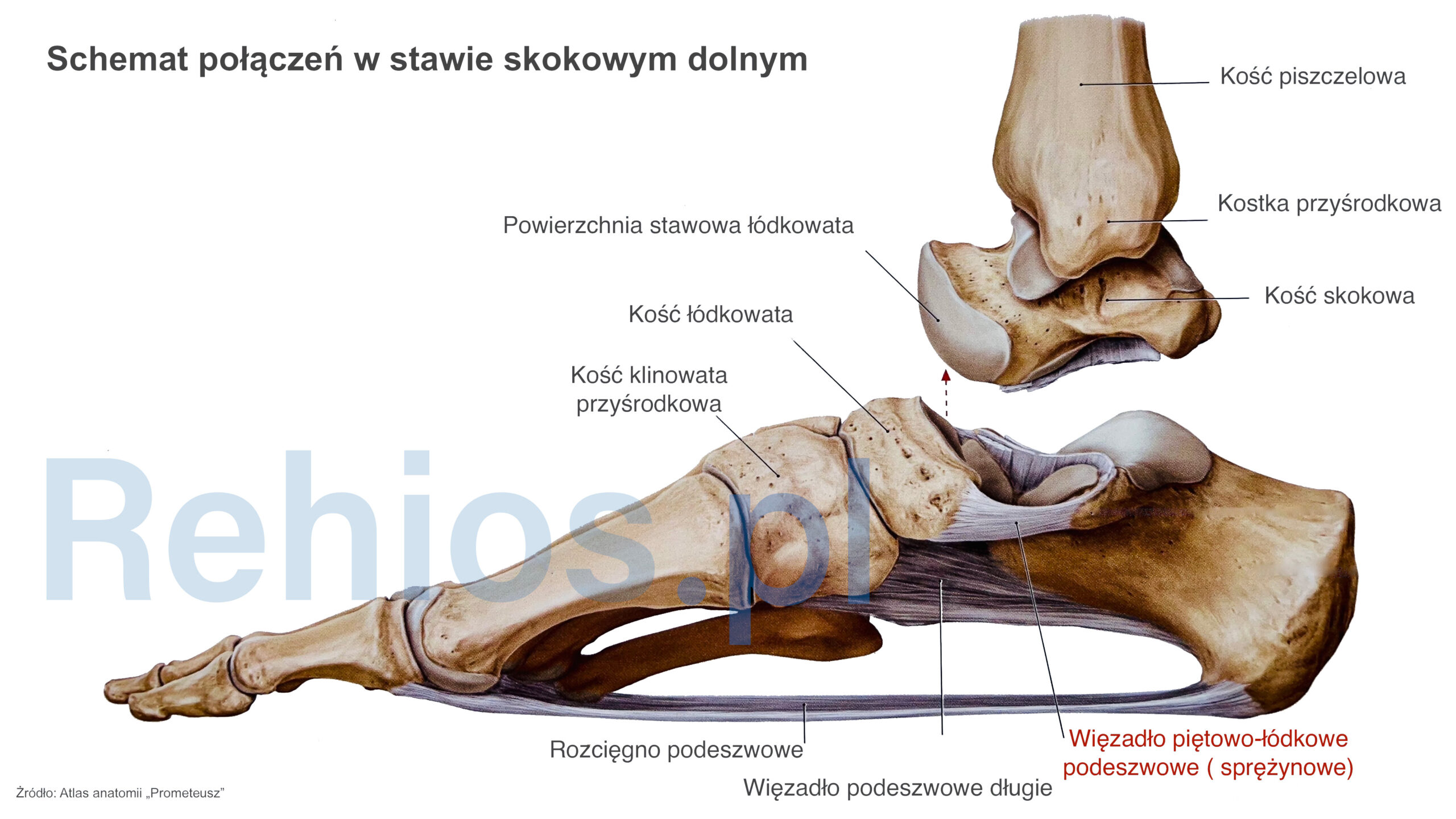 Leczenie ostrogi piętowej