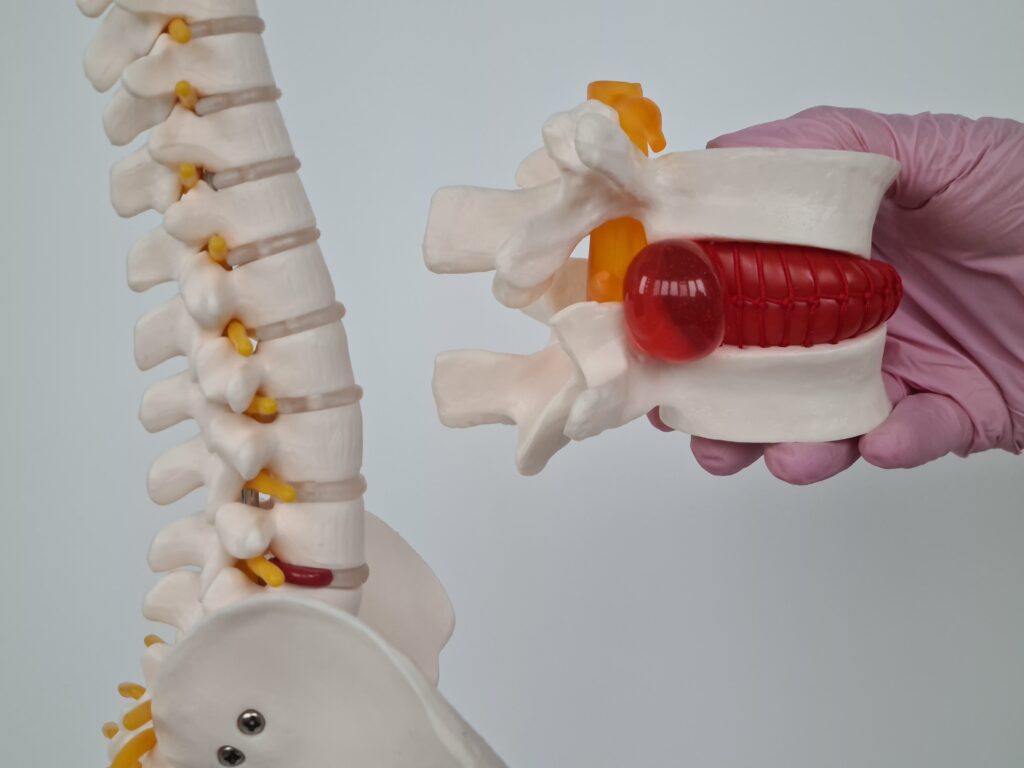 Uszkodzenie krążka międzykręgowego